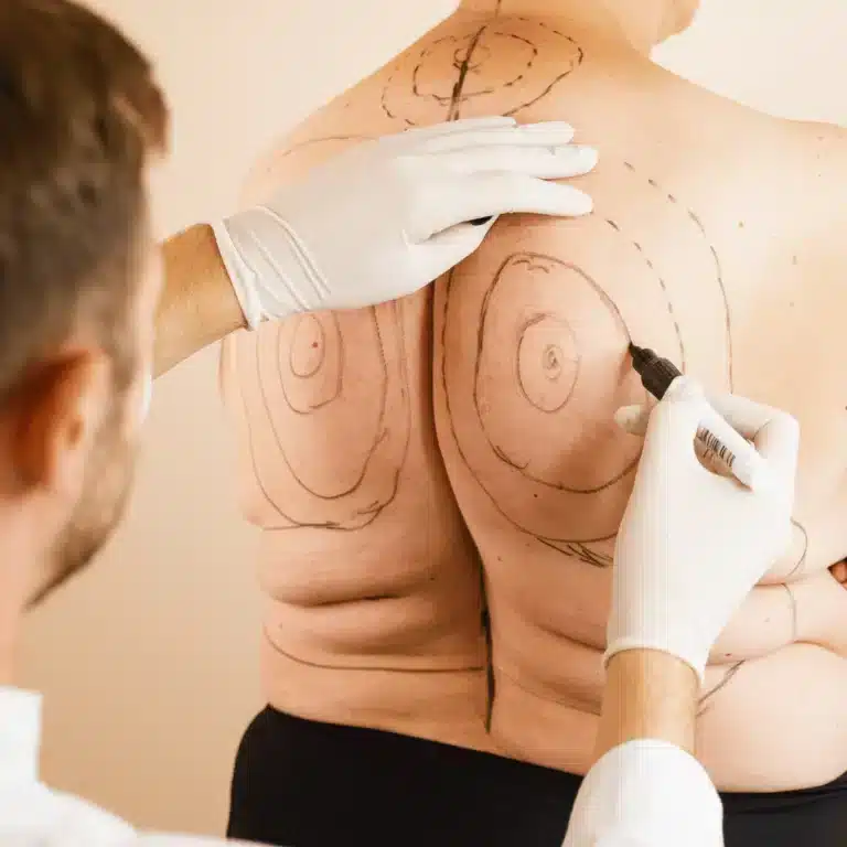 Vücut Şekillendirme: 360 Derece Liposuction Nedir ve Kimler İçin Uygundur? | Kapsamlı Rehber Tüm vücut çevresinden yağ alımını gösteren 360 derece liposuction görseli