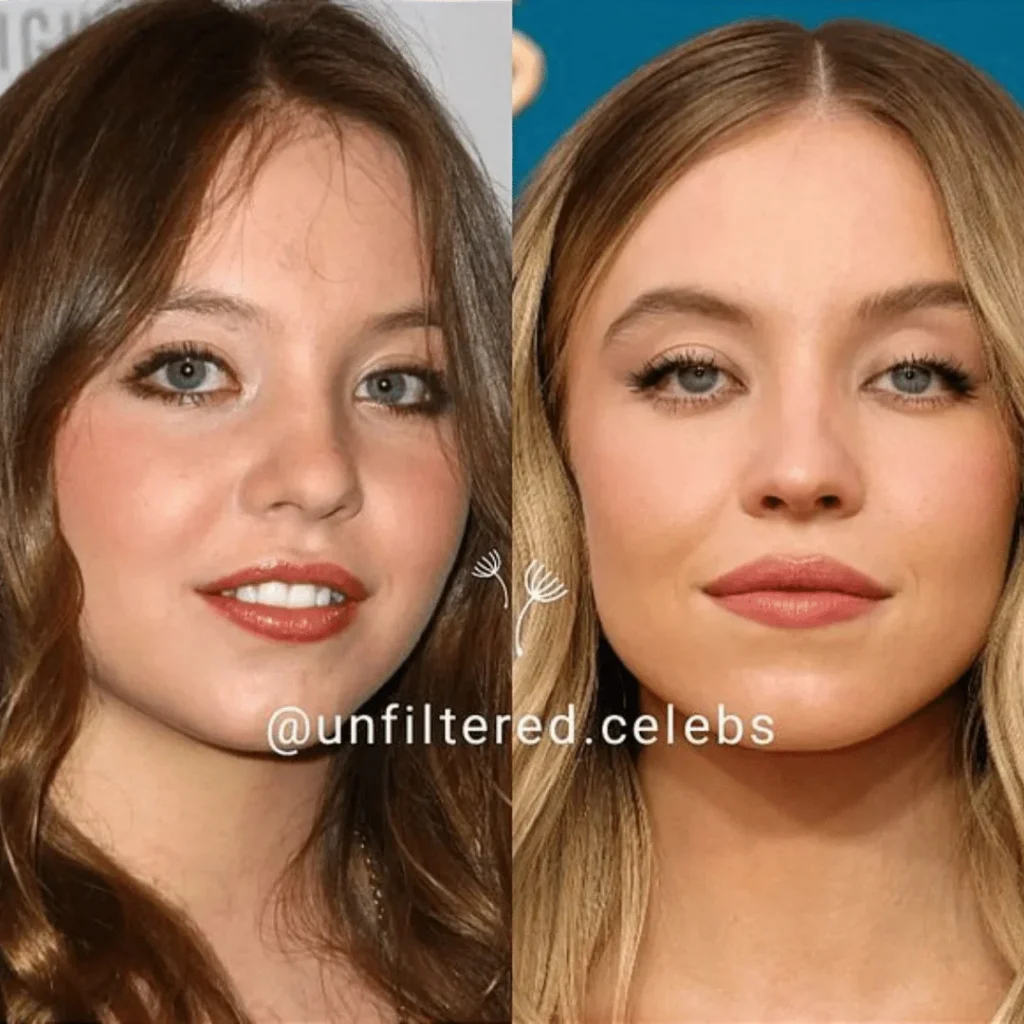 Sydney Sweeney Estetik Ameliyatları | Tüm Detaylar 1 Sydney Sweeney estetik ameliyatı öncesi ve sonrası yüz farkı