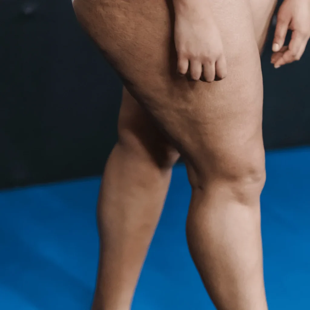 Uyluk germe ameliyatı öncesi ve sonrası bacak görünümü farkı