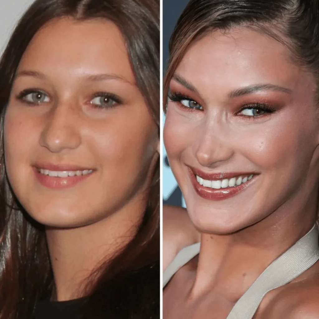 Bella Hadid Estetik Ameliyatları | Tüm Detaylar 1 Bella Hadid estetik ameliyatı öncesi ve sonrası yüz farkı