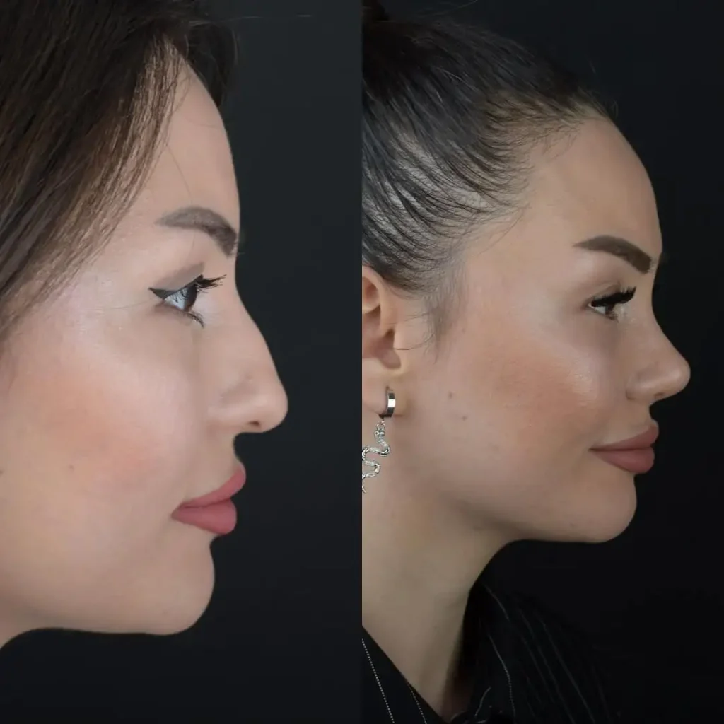 Profil görünümünde burun estetiği öncesi ve sonrası farkı