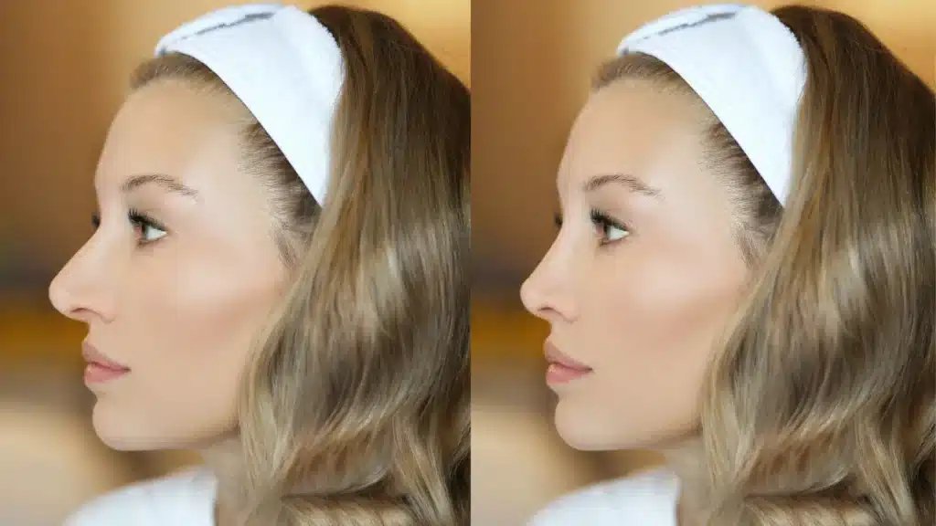 Rinoplasti sonrası yüz hatları belirginleşmiş hasta görseli