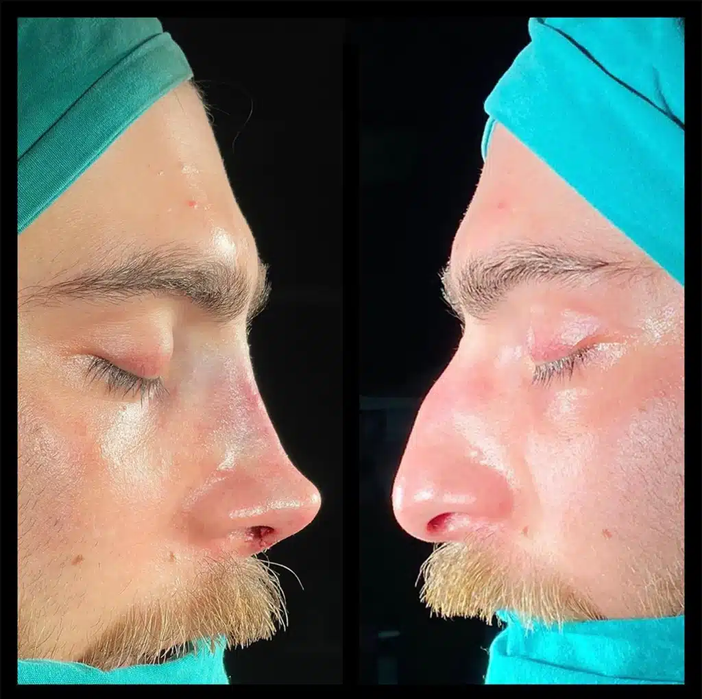 Rinoplasti öncesi ve sonrası aynı hastanın karşılaştırmalı fotoğrafı