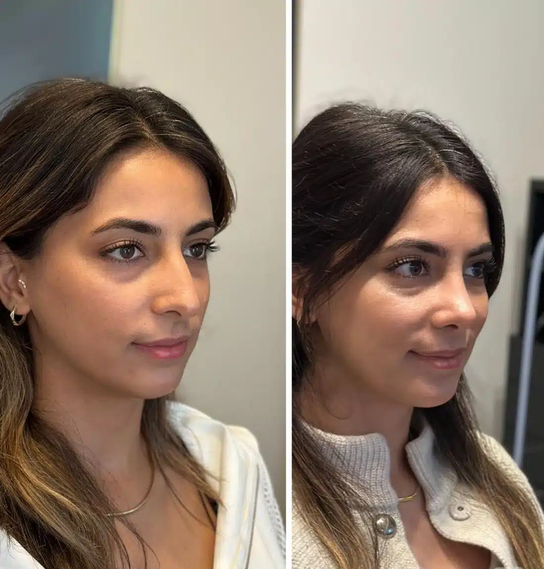 Kadın hasta rinoplasti öncesi sonrası estetik farkı