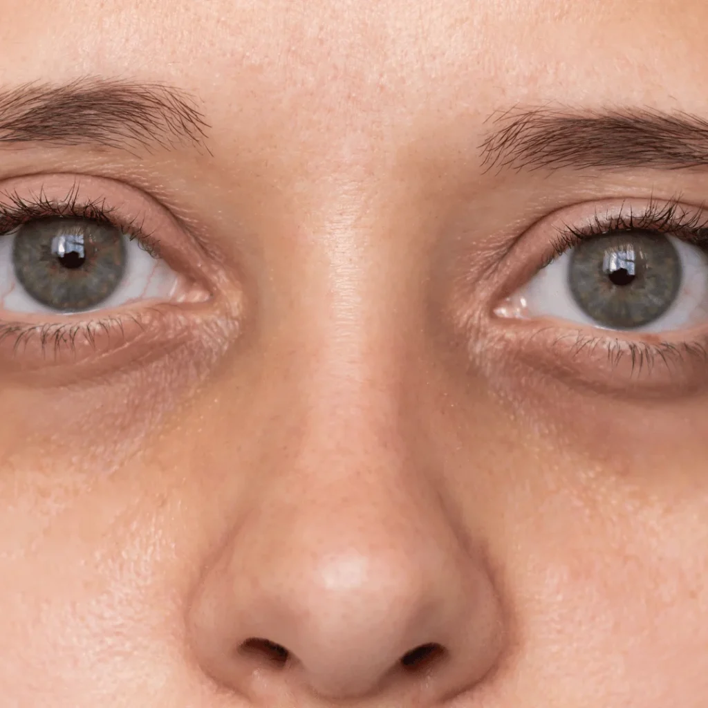 Canthopeksi Ameliyatı Nedir? Çekik göz şekillendirme ameliyatı 1 Canthopeksi ameliyatı sonrası daha çekik ve kalkık göz görünümü