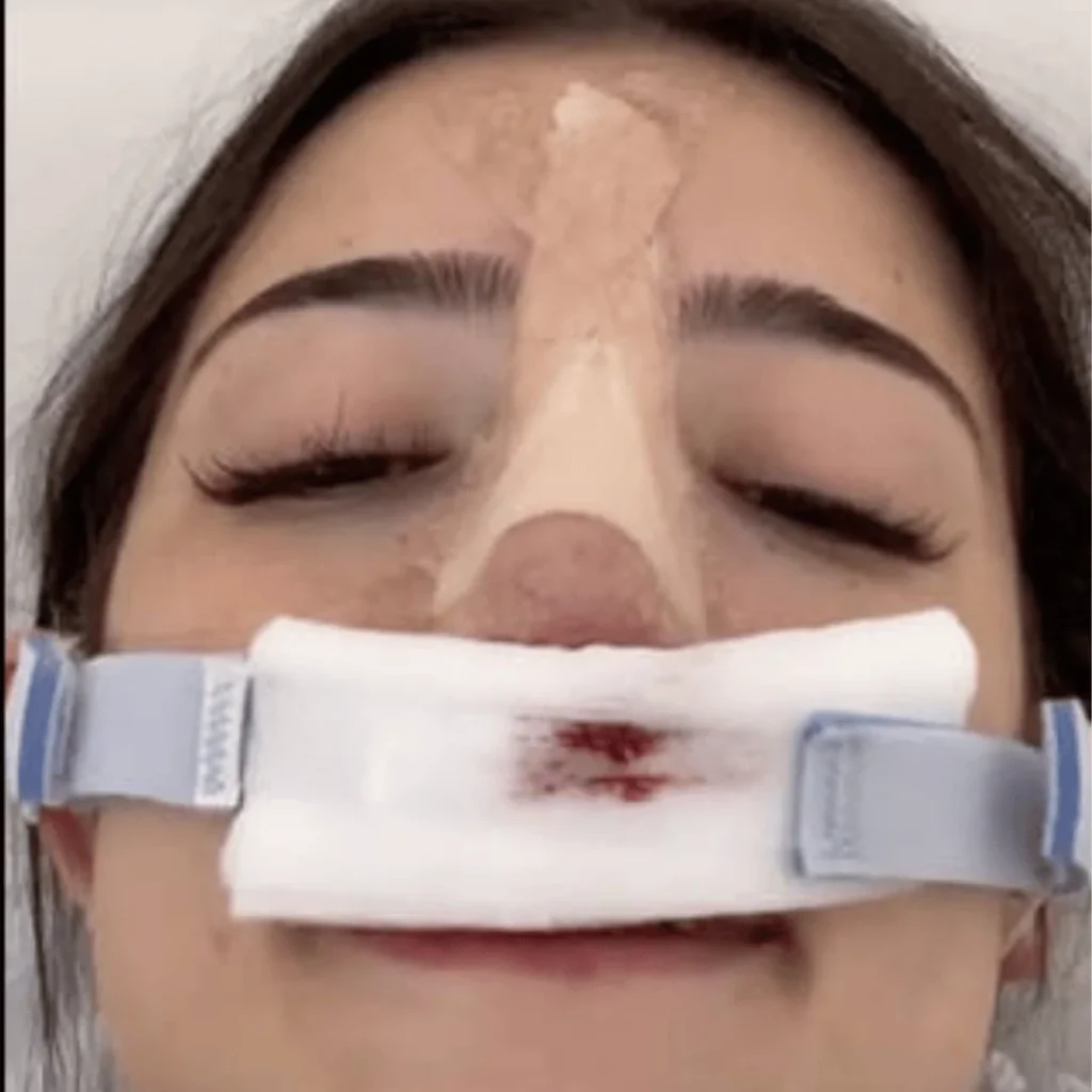 Charli D’Amelio Estetik Ameliyatları | Tüm Detaylar 1 Charli D’Amelio estetik ameliyatı öncesi ve sonrası yüz farkı