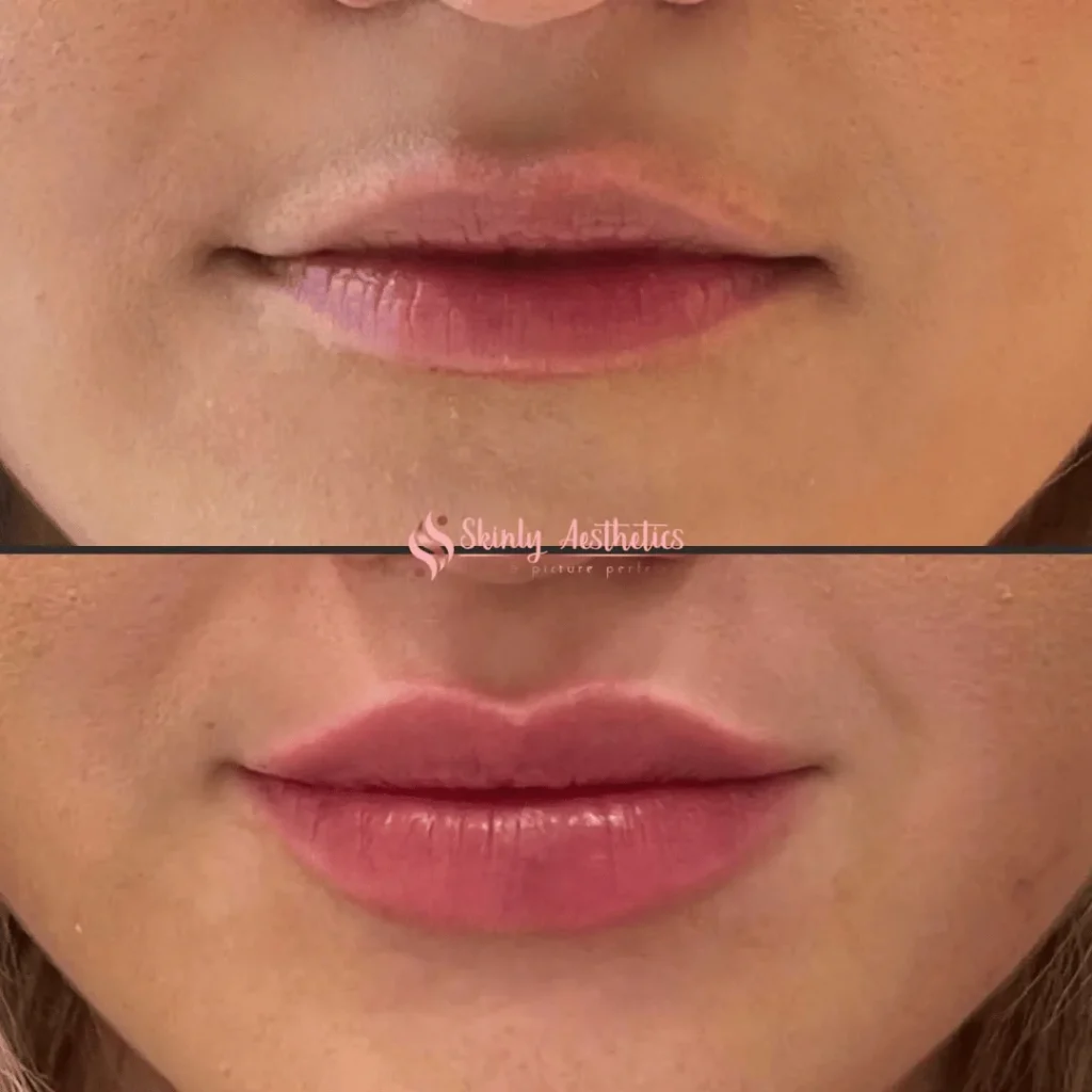 Dudak Dolgusunda Yeni Nesil Yaklaşım