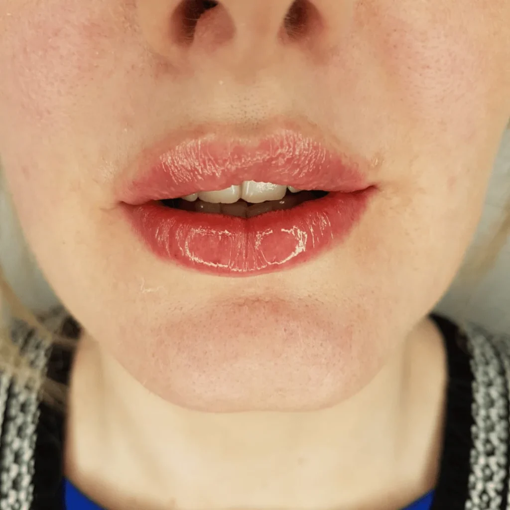 Dudak Estetiğinde Uzman Dokunuş