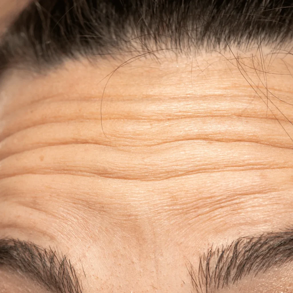 Alın bölgesindeki kırışıklıkları ve sarkmaları gidermek için uygulanan alın germe estetiği görseli