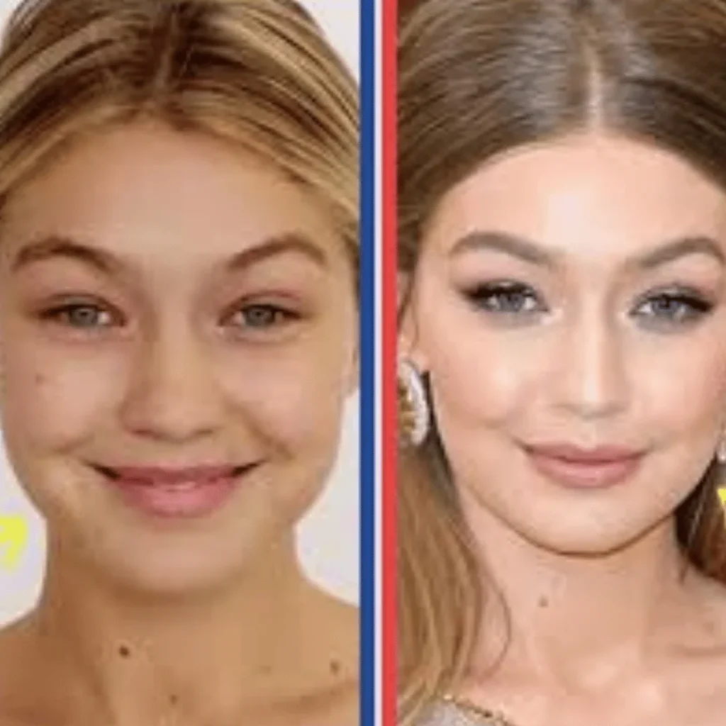 Gigi Hadid Estetik Ameliyatları | Tüm Detaylar 1 Gigi Hadid estetik ameliyatı öncesi ve sonrası yüz değişimi