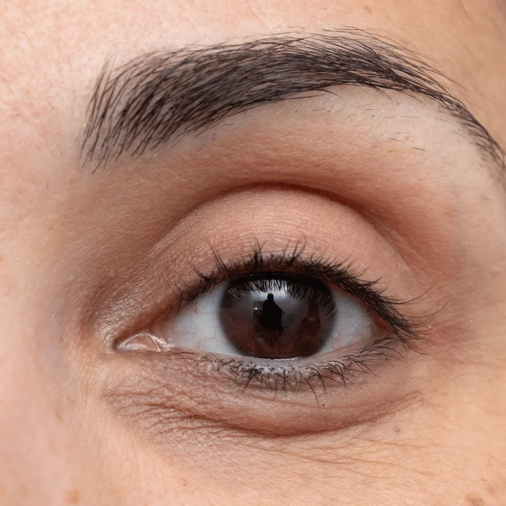 Göz altındaki morlukları ve çöküklükleri gideren ışık dolgusu uygulaması görseli