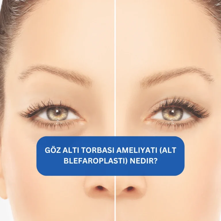 Göz Altı Torbası Ameliyatı (Alt Blefaroplasti) Nedir? Göz altı torbalarının alınması Göz altı torbalarını alan estetik ameliyat öncesi ve sonrası görseli