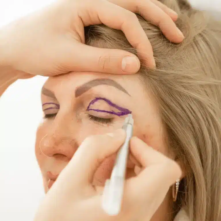 Göz Kapağı Estetiği (Blefaroplasti): Bilmeniz Gereken Her Şey | Kapsamlı Rehber Göz kapağı estetiği sonrası göz çevresi görünümü