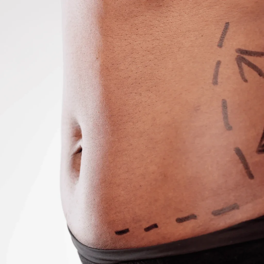 Karın germe ameliyatı sonrası vücut görünümünde değişim