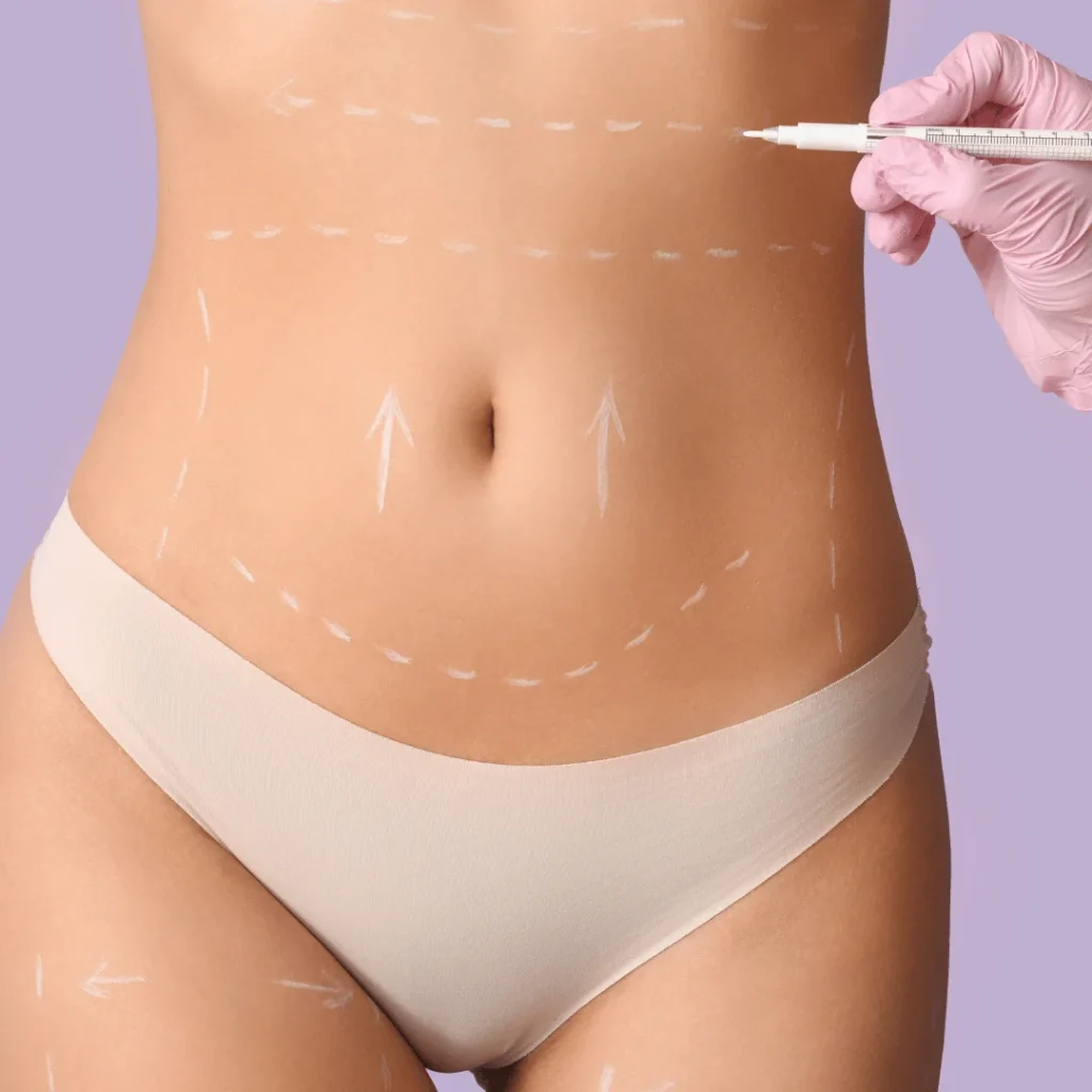 Karın Germe Ameliyatı (Abdominoplasti) Nedir?