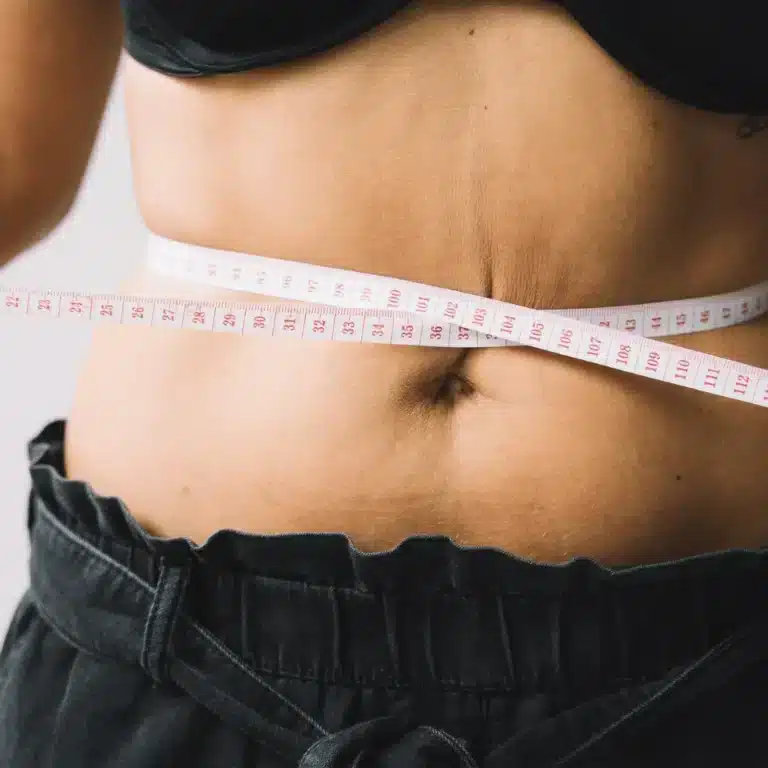 Karın Germe Ameliyatı Sonrası İyileşme Süreci: Gün Gün Ne Beklemeli? | Uzman Rehberi Karın germe ameliyatı sonrası görüntü ve vücut şekillendirme süreci