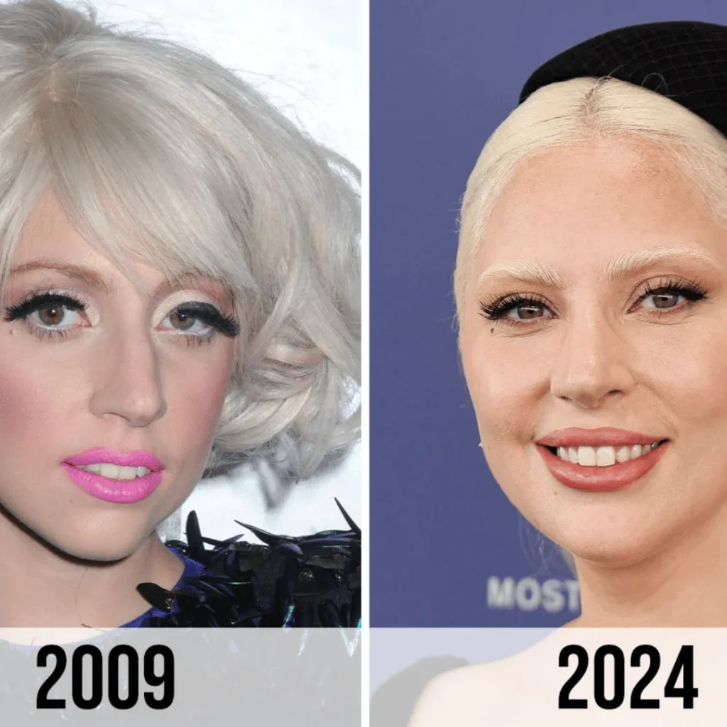 Lady Gaga Estetik Ameliyatları | Tüm Detaylar 1 Lady Gaga estetik ameliyatı öncesi ve sonrası yüz farkı