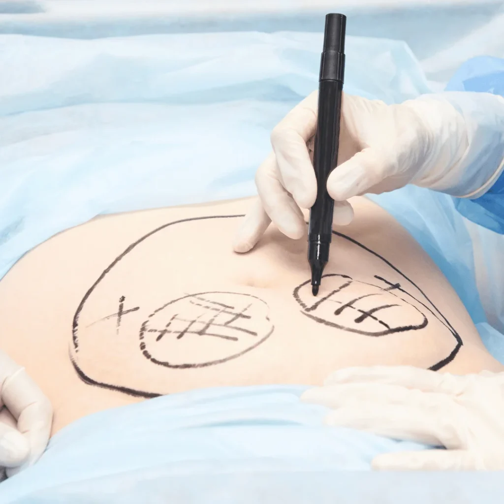 Liposuction işlemine giren hastayı gösteren temsili ameliyat sahnesi