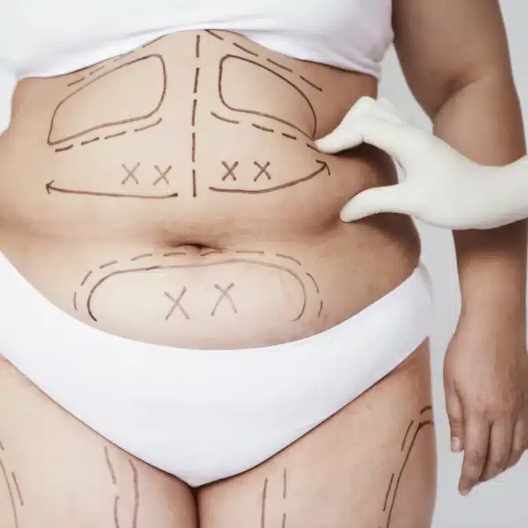 Liposuction Sonrası Dalgalanma Neden Olur ve Nasıl Önlenir? | Kapsamlı Rehber Liposuction ameliyatı sonrası vücut şekillendirme görseli