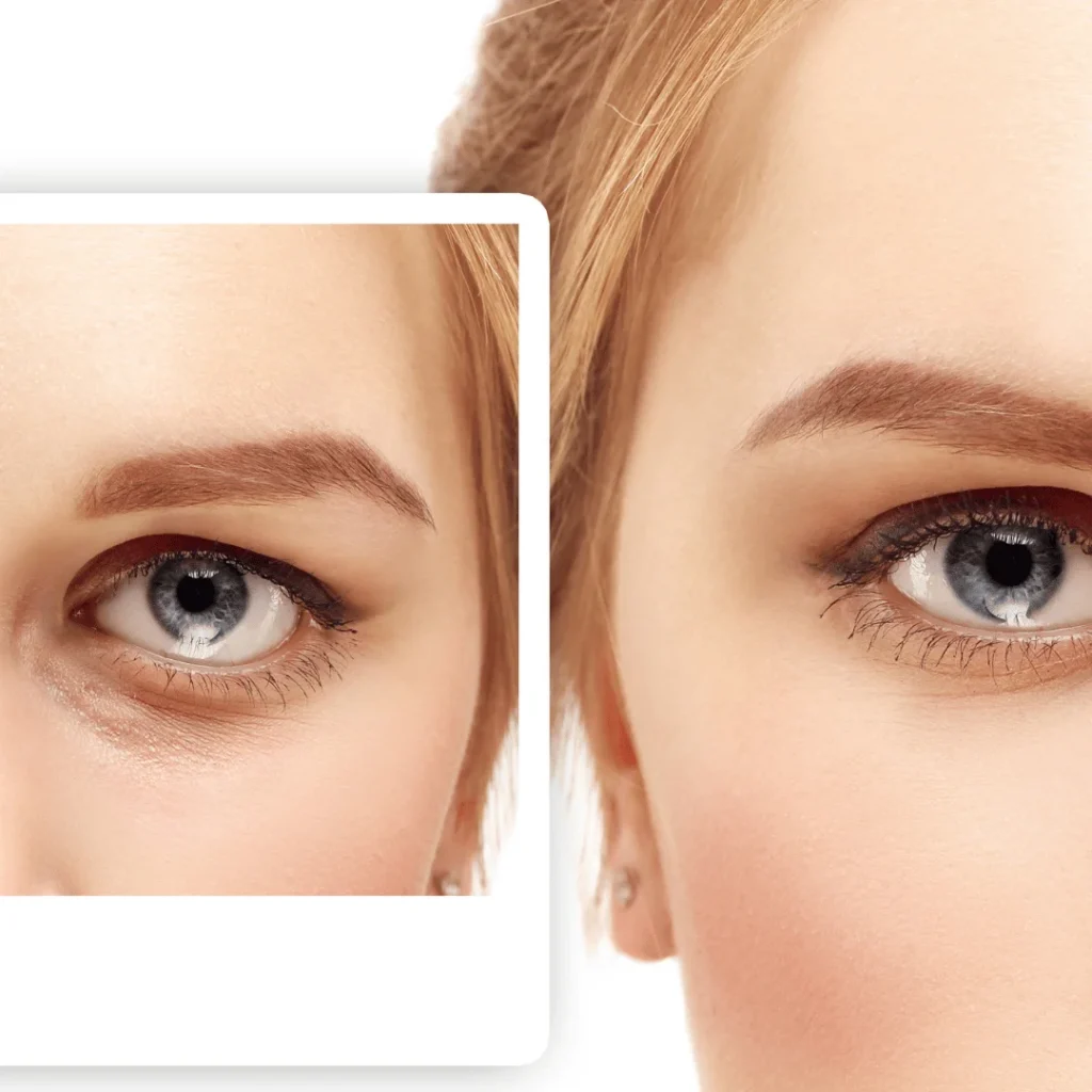 Göz altı torbalarını azaltarak gençleştirilen göz çevresi görünümü