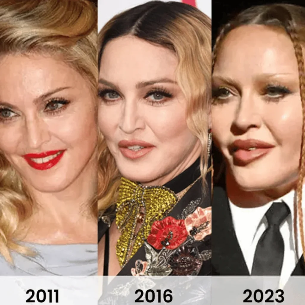 Madonna Estetik Ameliyatları | Tüm Detaylar 1 Madonna estetik ameliyatı öncesi ve sonrası yüz değişimi
