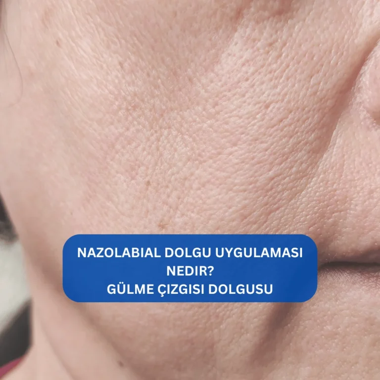 Nazolabial Dolgu Uygulaması Nedir? Gülme çizgisi dolgusu Nazolabial bölgeye uygulanan dolgu sonrası daha genç yüz görünümü