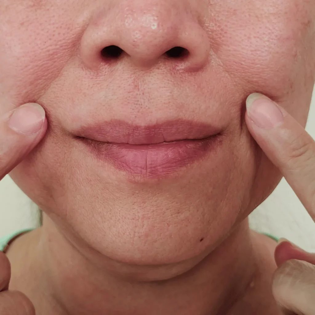 Nazolabial çizgileri azaltmak için uygulanan dolgu tedavisi görseli