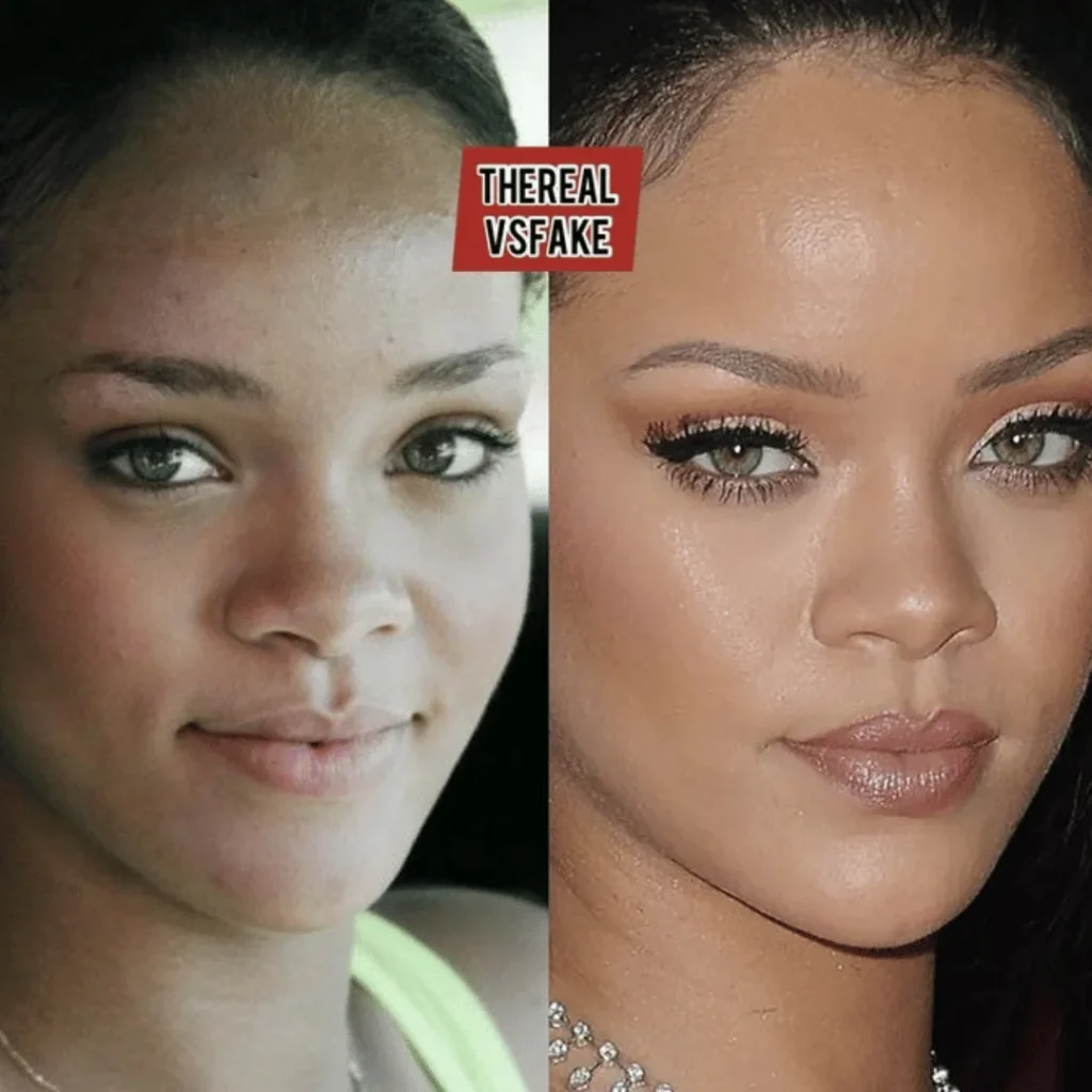 Rihanna Estetik Ameliyatları | Tüm Detaylar 1 Rihanna estetik ameliyatı öncesi ve sonrası yüz değişimi