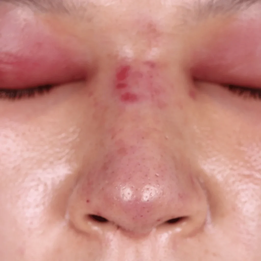 Doktorla görüşmeden ameliyat anına ve bandajlı burun sonrası görünüme kadar 3 aşamalı süreç