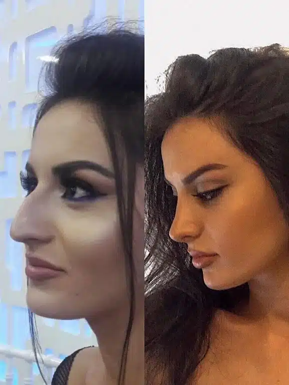 Burun estetiği öncesi ve sonrası kadın hasta dönüşümü