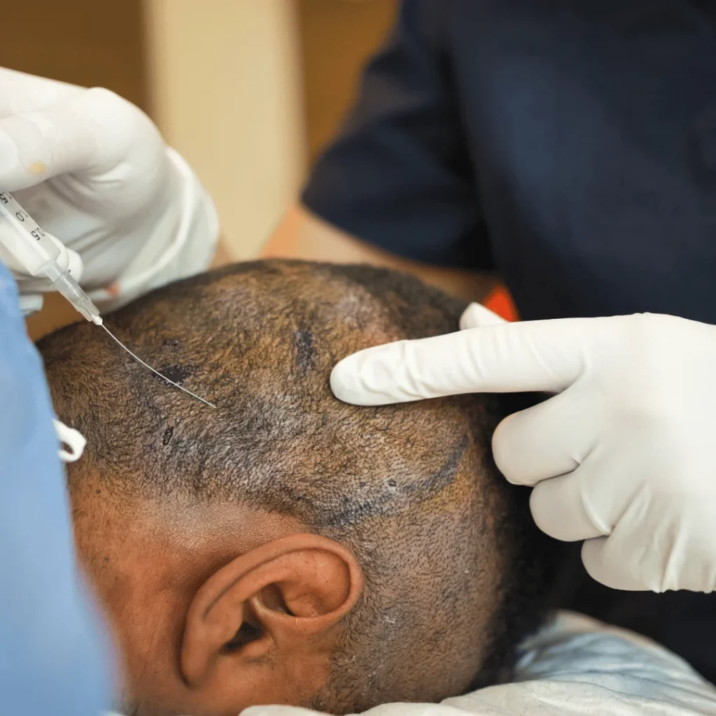 Saç Ekimi Ameliyatı Nedir? Kalıcı saç çözümü 1 Saç dökülmesi yaşayan bireylerde uygulanan saç ekimi operasyonu görseli