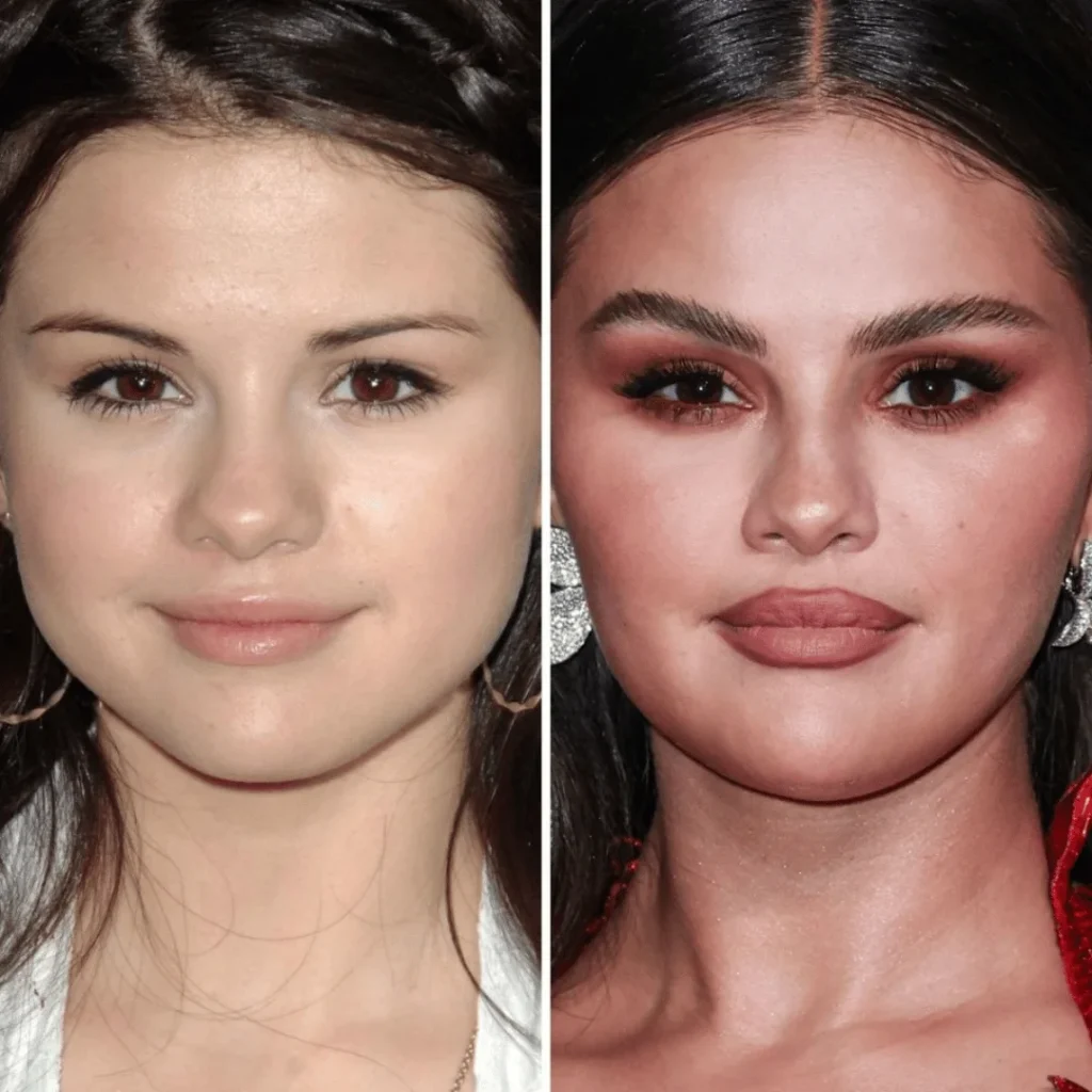 Selena Gomez Estetik Ameliyatları | Tüm Detaylar 1 Selena Gomez estetik ameliyatı öncesi ve sonrası yüz farkı