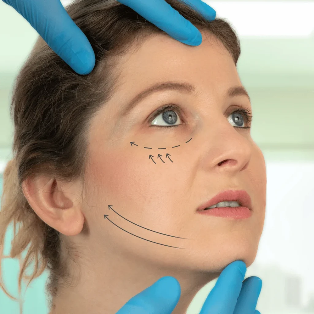 Yüz kaslarının altındaki SMAS tabakasını gösteren anatomik şema