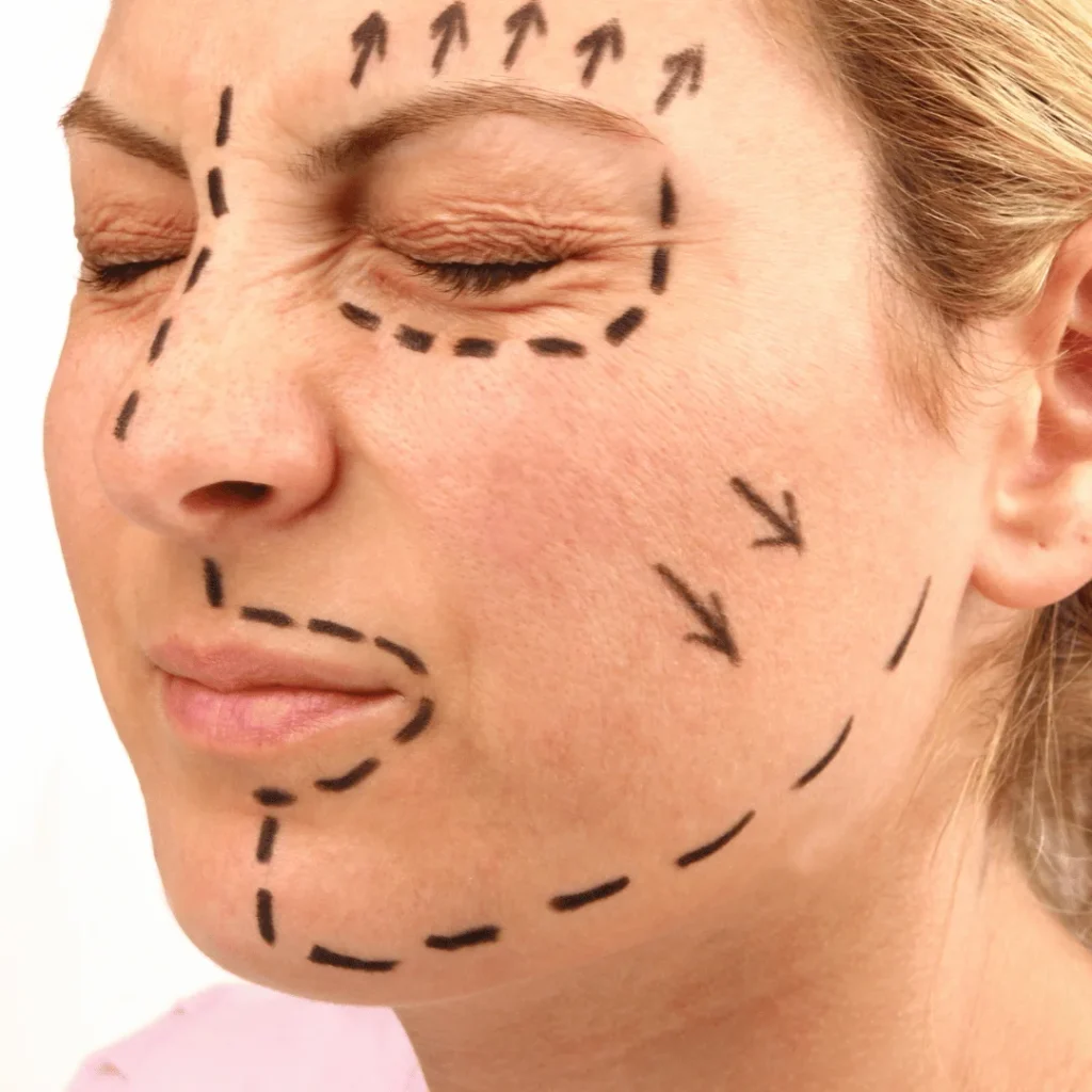 Yüz Germe (Facelift) Ameliyatı Nedir? Yaşlanma karşıtı estetik 1 Facelift sonrası yüz hatlarında meydana gelen değişimi gösteren görsel