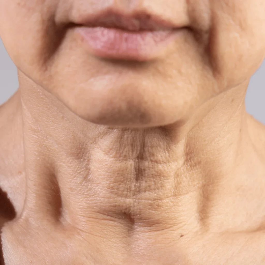 Yüz Sarkması Neden Olur ve Gerçekten Önlenebilir mi? 1 Cilt altı dokuların zayıflamasıyla oluşan yüz sarkmasını anlatan şematik görsel