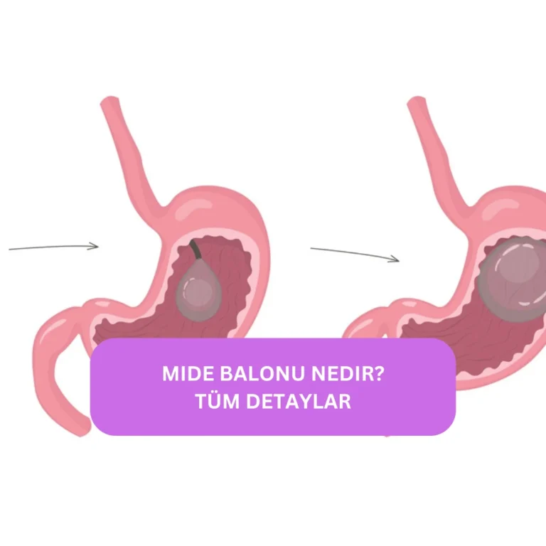 Mide Balonu Nedir? Ameliyatsız Zayıflama Hakkında Tüm Detaylar Mide balonunun faydaları ve olası yan etkileri hakkında tablo