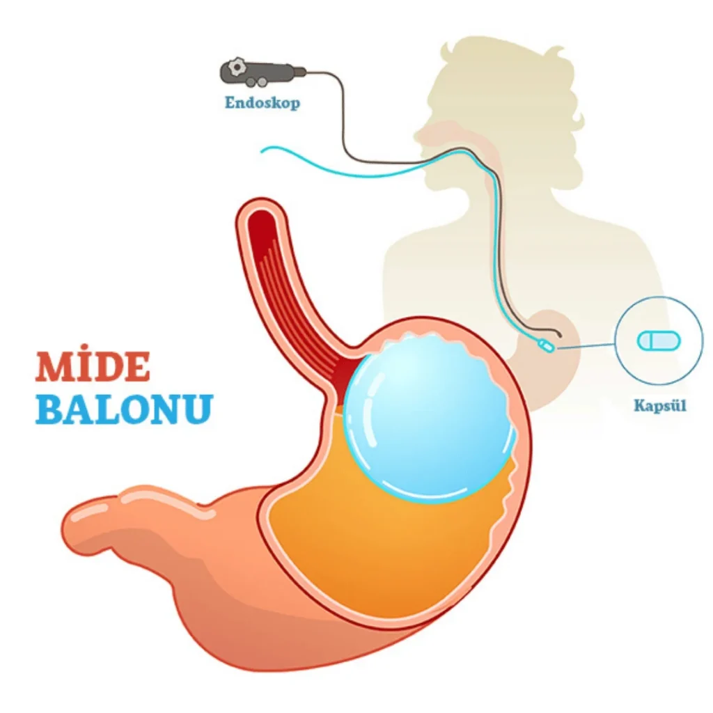 Mide Balonu Nedir ve Nasıl Uygulanır?